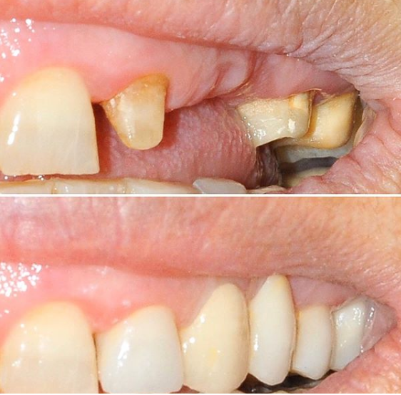 Coronas dentales