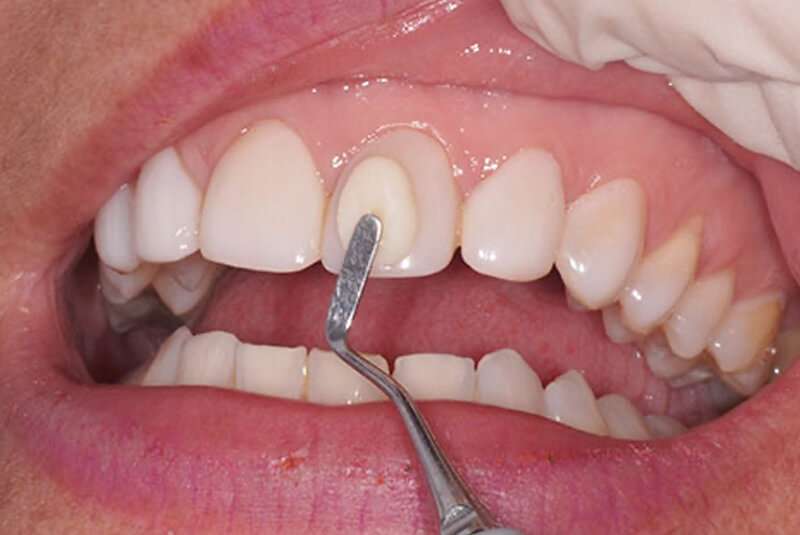 Carilla dental